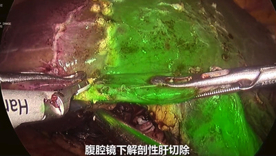肝癌切除.jpg