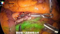 第二代LED直腸癌手術2.jpg